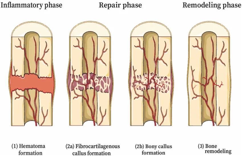 The stages of bone repair